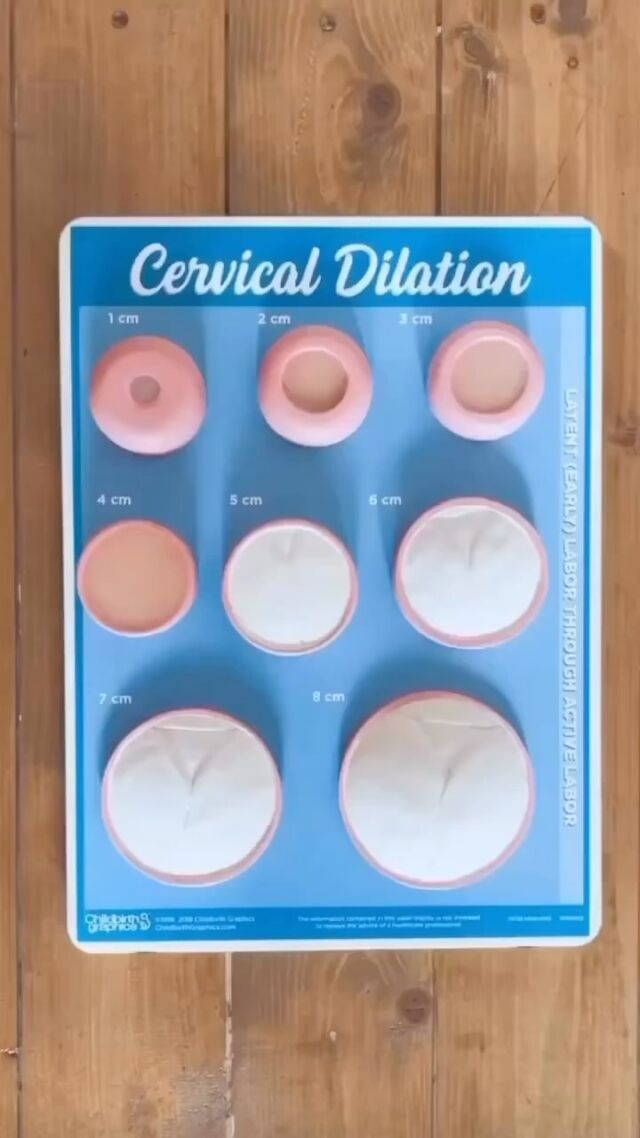 Cervical dilation… or opening. What is it and what is this demo showing us? 

🔘 Your cervix is the opening of the uterus, your uterus is the balloon shape that your baby is snuggled up in. 

🔘 The cervix literally looks like the opening of a blown up balloon- long and thick. During pregnancy, this is closed and ticked back, keeping baby tucked up safely inside.

🔘 At 1cm you can see the opening of the cervix is still thick. Baby’s head is starting to put pressure on from above, and mild waves (contractions) are causing the cervix to open, by drawing up the uterus muscles. 

🔘 As we go around this demo, the cervix opens and thins (effaces) until you can barely see it, with baby’s head starting to crown at around 8cm. 

〰️ Generally, waves (contractions)  increase in intensity as the cervix opens more, as they are working harder to open up the cervix.

This process can take hours or days, every body is different. The things to remember are:

🤍 Breathe deeply (to fuel your body with the oxygen it needs to undertake this incredible process)

🤍 Be as upright, forward and open as you can. Lying down doesn’t help this process, as it makes the birth path ‘uphill’ for baby, and slightly closes it. If you do need to lie down then tilt yourself to the side with pillows behind your back and prop your legs open with more pillows or a peanut ball. Being as open as possible, and not closing the pelvis through lying down will really help.

🤍 Allowing your birthing hormones to develop is key too- you need to feel safe, supported and listened to.

Having an induction or medicated pain relief? This all still applies.

Any questions? Drop them in the comments below 🤍

-

#stagesoflabour #atyourcervix #amazingbodies #mindfulbirth #mindfulbirthforallbirths #pregnancy #birth #birthdemo